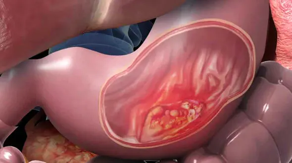 انواع بیماری های معده 