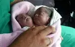 تولد نوزاد دو سر+ عکس