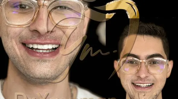 لمینت دندان چیست ؟ (معرفی+قیمت+نمونه کار)