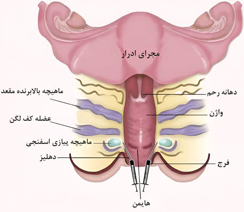 _درمان واژینیسموس