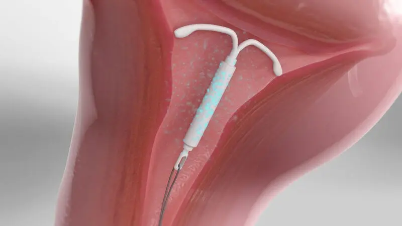 آی یو دی (IUD)