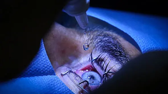 هشدار جدی سازمان غذا و دارو درباره تبلیغات قطره های چشمی در فضای مجازی / خطر جداشدگی شبکیه و تاری دید در راه است