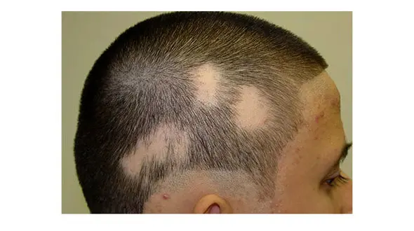 علت اصلی ریزش موی سکه ای  نوعی بیماری خود ایمنی است