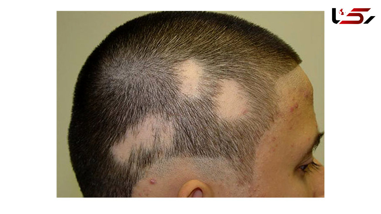 علت اصلی ریزش موی سکه ای  نوعی بیماری خود ایمنی است