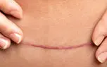 اسکار پوستی چیست؟ / جدول روش‌ های کاهش اسکار پوستی