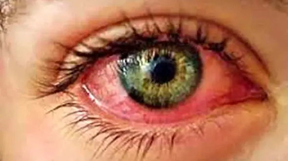 بیماری های رایج چشم  را بشناسید+ راهکارهای درمانی