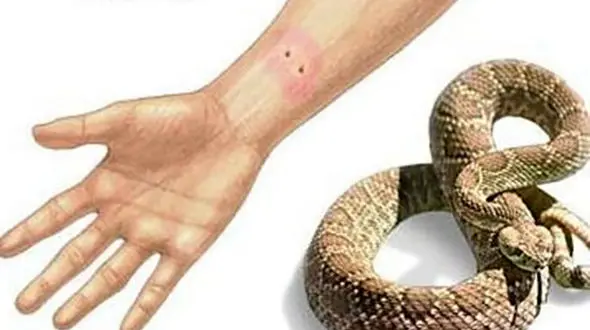 راهکارهای کمک به فرد مارگزیده