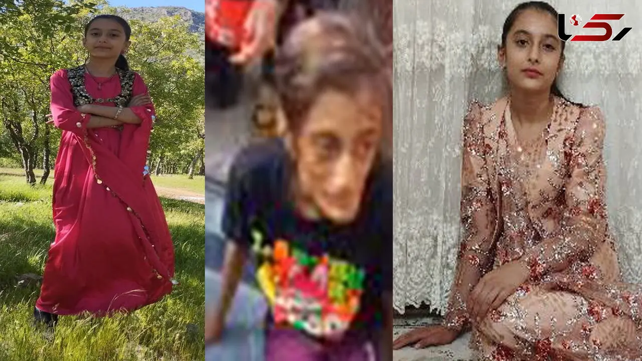 فیلم / نارین دختر نوجوان سنندجی برای دومین بار زیر تیغ جراحی رفت / یک ماه زندانی پدر و نامادری اش بود