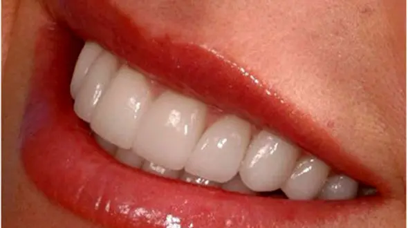 با پرینتر سه بعدی دندان مصنوعی ساخته شد