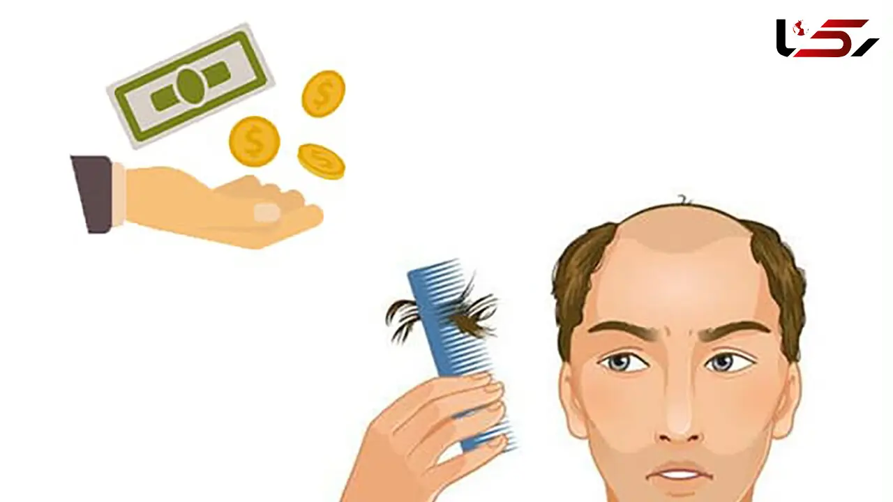 وام کاشت مو چه وامی است؟ + جدول