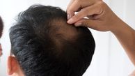 ارتباط دیابت با ریزش مو و راه های درمان