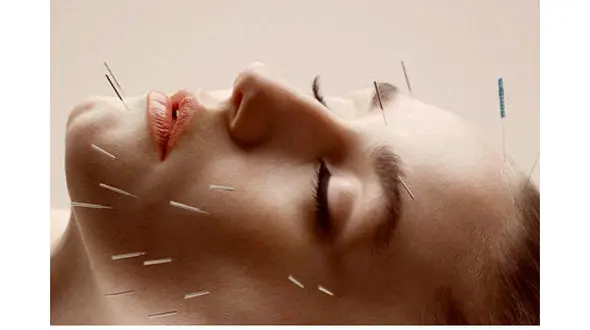 زیبایی طبیعی چهره و اندام بدن با طب سوزنی 