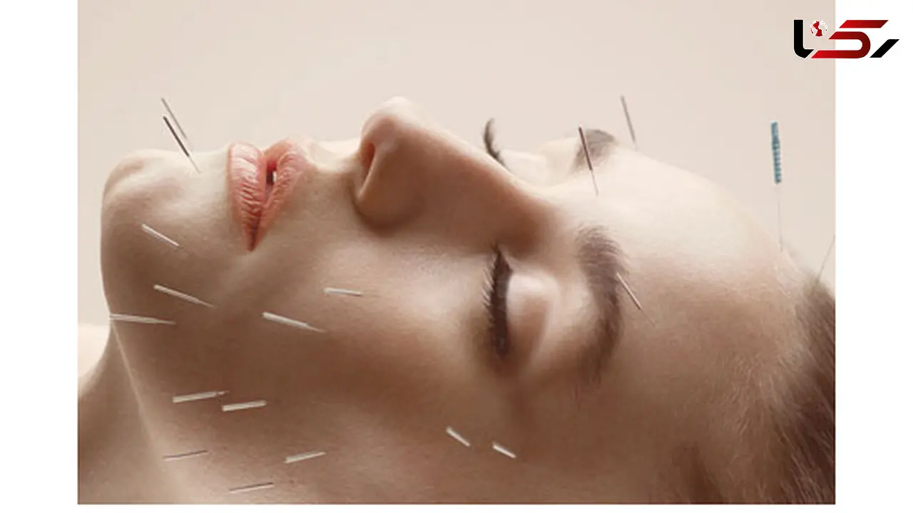 زیبایی طبیعی چهره و اندام بدن با طب سوزنی 