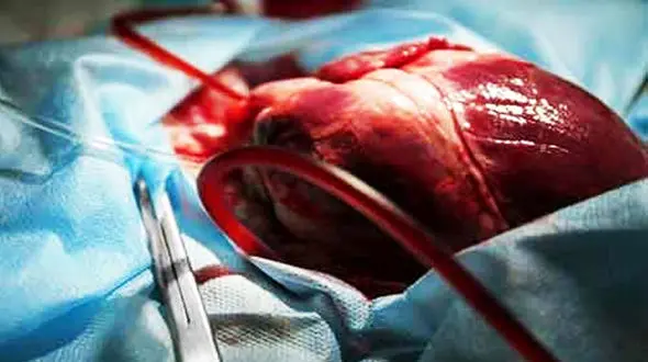 چطور قبل از پیوند از قلب نگهداری می شود؟ + فیلم
