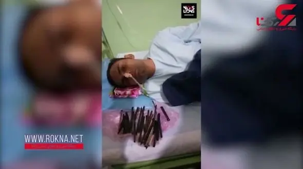 خارج کردن فلزات خطرناک از شکم جوان نگون بخت ! +فیلم