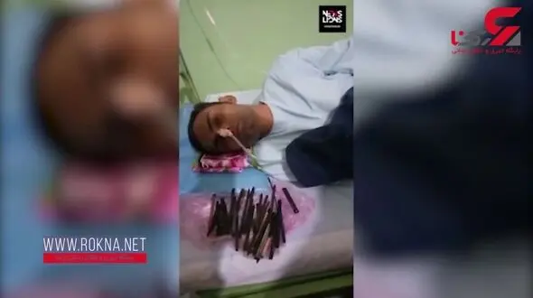 خارج کردن فلزات خطرناک از شکم جوان نگون بخت ! +فیلم