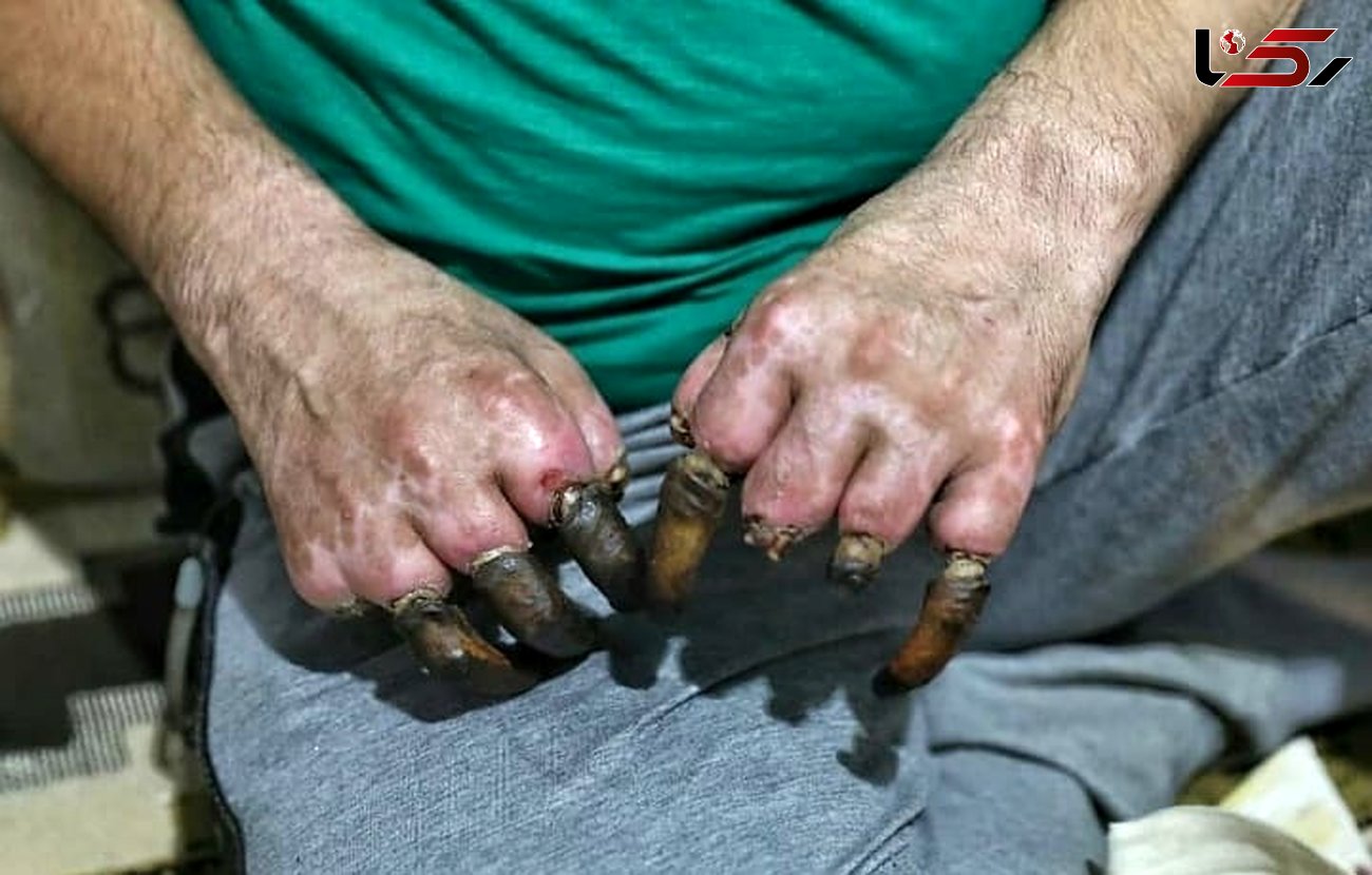 این عکس دردناک برای یک کولبر است / انگشتان او یکی پس از دیگری می افتند+ تصویر