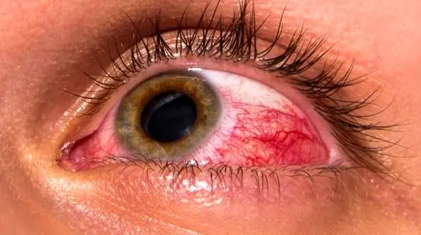 خطر زخم قرنیه با لنزهای دائمی