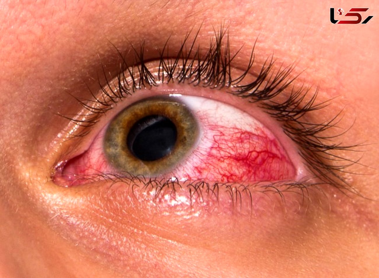 خطر زخم قرنیه با لنزهای دائمی