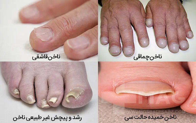 تغییر شکل ظاهری ناخن در اثر بیماری های ناخن