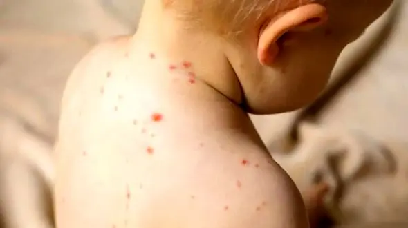 سرخک در ایران در وضعیت قرمز؛ مینو محرز زنگ خطر را به صدا درآورد