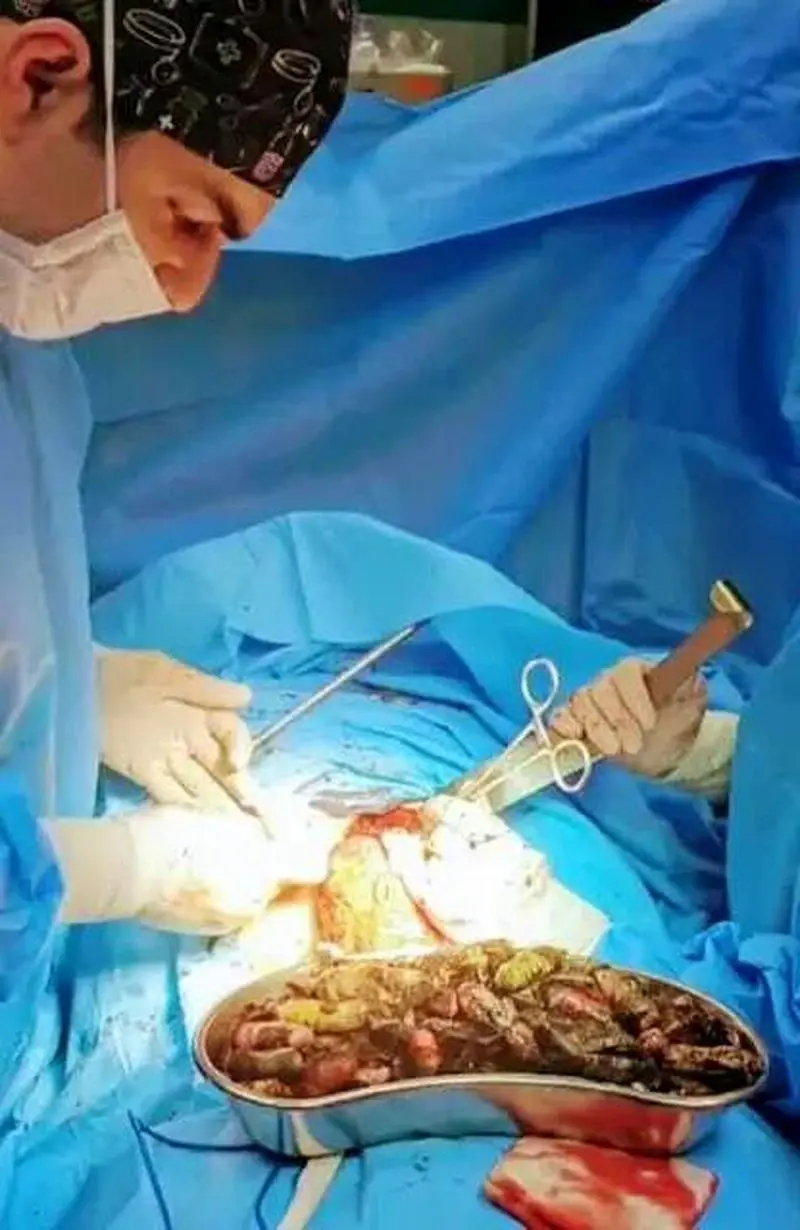 خروج ۹۰ بسته مواد مخدر از معده و روده بیمار در کرج