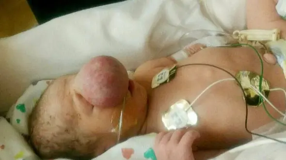 بخشی از مغز این کودک بیرون از سرش بود / بیماری عجیب این کودک پزشکان را به چالش کشید+تصاویر