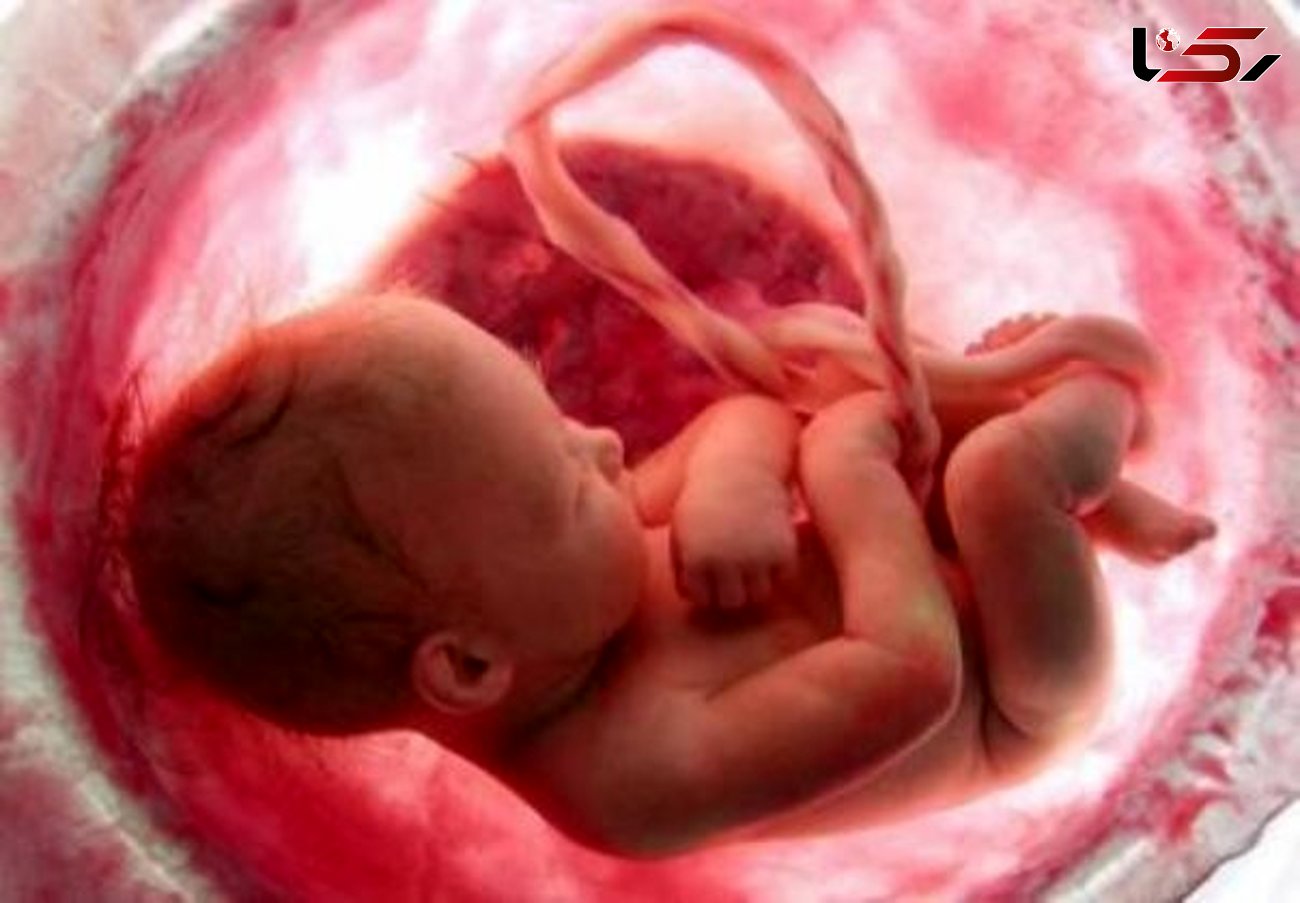 4 فاکتور اصلی در سقط جنین