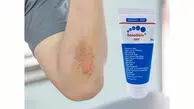 معجزه ژل جدید و عجیب برای درمان زخم بستر 