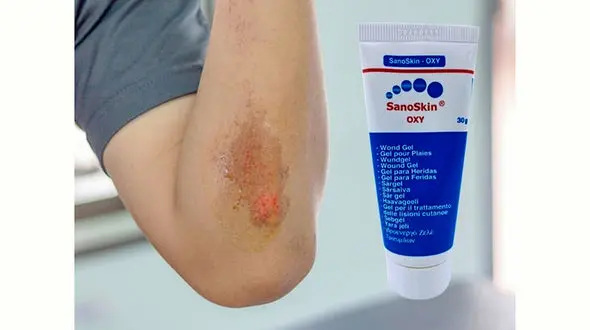 معجزه ژل جدید و عجیب برای درمان زخم بستر 