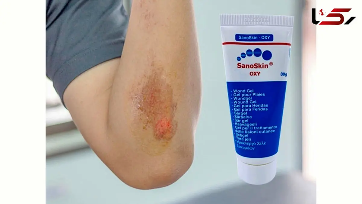 معجزخ ژل جدید و عجیب برای درمان زخم بستر 