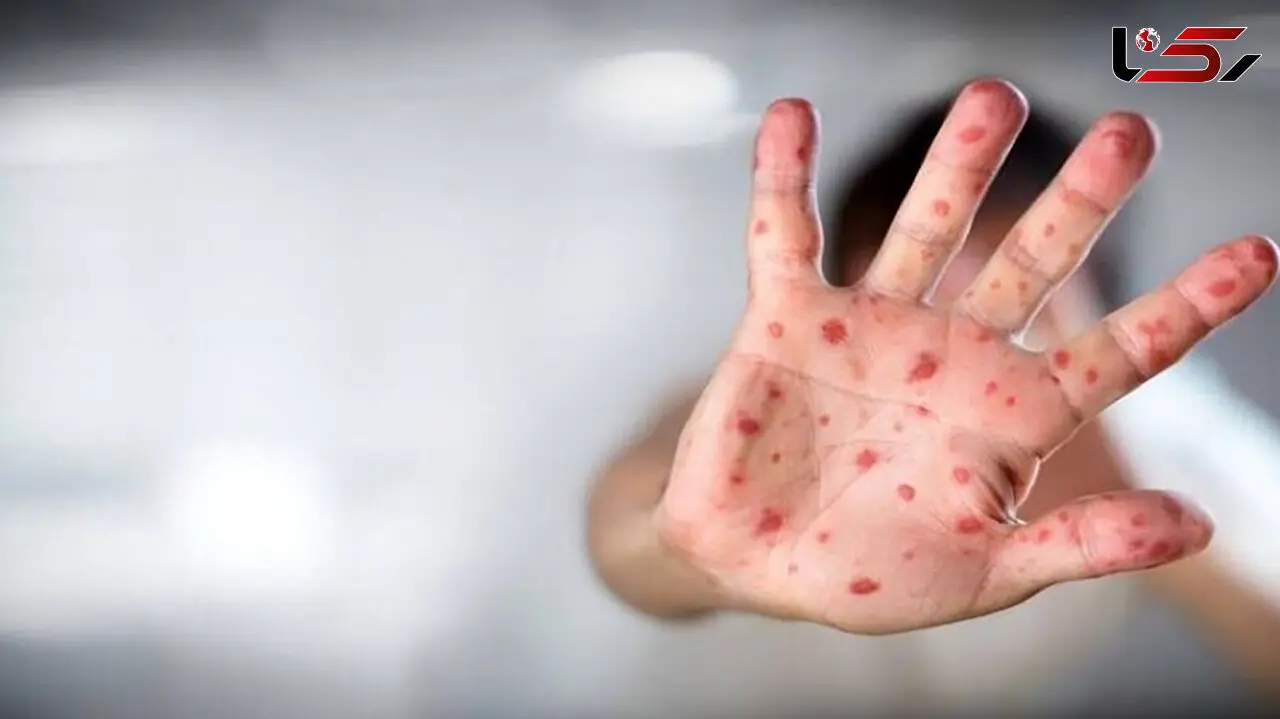 آبله میمون خطر متوسط برای سلامت عموم دارد