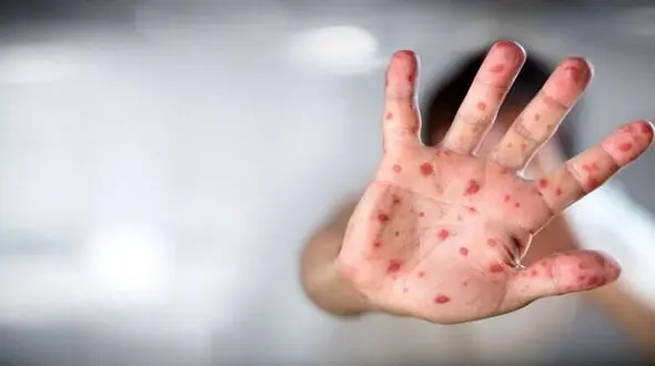 آبله میمون خطر متوسط برای سلامت عموم دارد