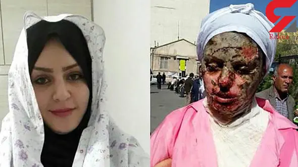 آخرین جزئیات درمان «معصومه» قربانی اسیدپاشی تبریز + فیلم