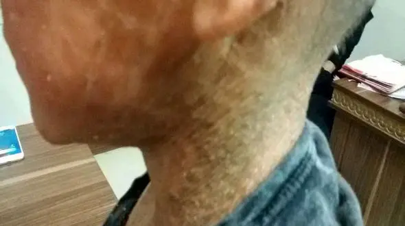 بیماری پوستی اکتیوز چیست؟/ تصاویر تلخ از بیماری اکتیوز