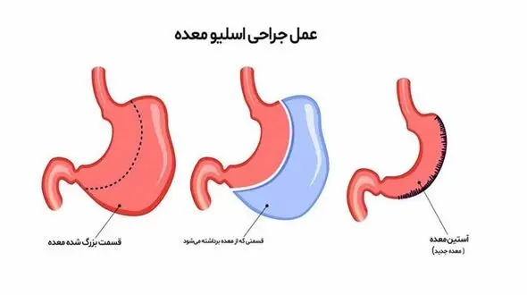 اسلیو چیست؟ + جدول مزایا و معایب