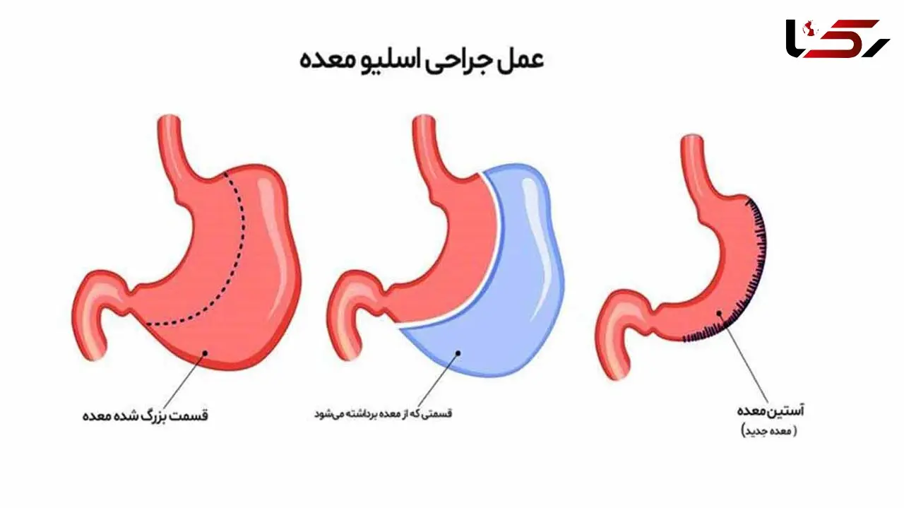اسلیو چیست؟ + جدول مزایا و معایب
