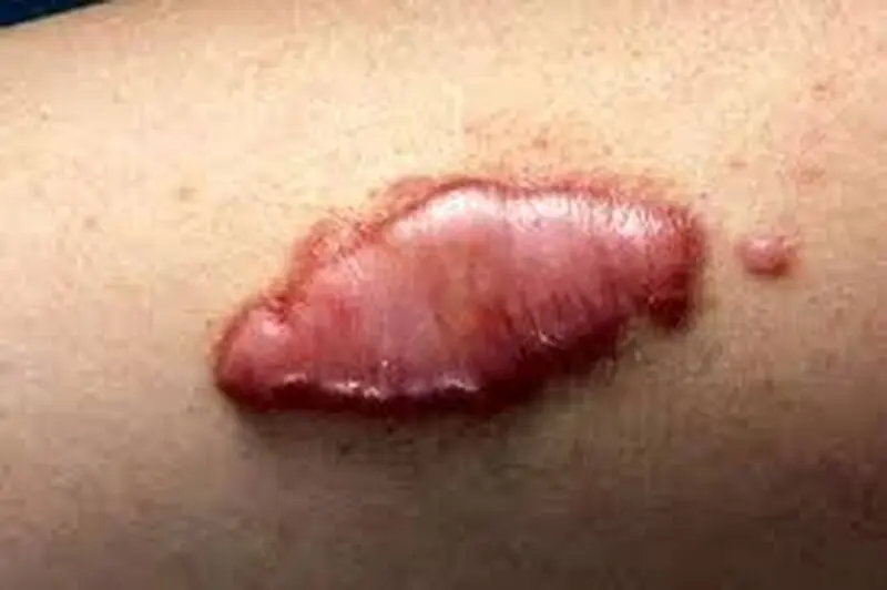 اسکار پوستی