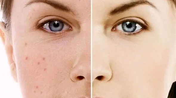 روش جوان سازی پوست تا شب عید