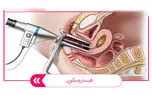 هیستروسکوپی چیست؟ / 12 سوال مهم درباره هیستروسکوپی + فیلم