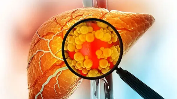 آیا مصرف زیاد آب منجر به چرب شدن کبد می شود؟