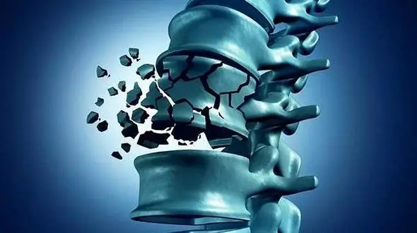  درمان پوکی استخوان با جدیدترین تکنیک