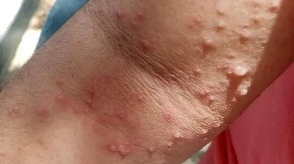 علت تا درمان آبله میمونی + اینفوگرافیک 