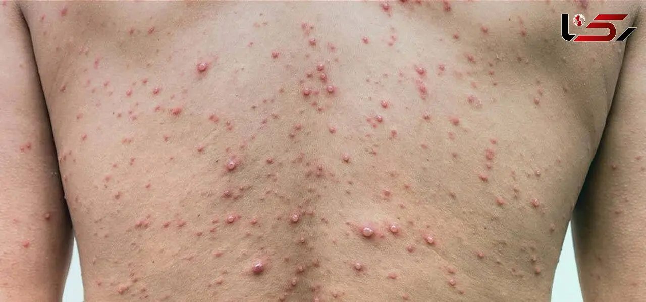 مرگ بالای 25 درصد از مبتلایان به HIV در 1400/ از کل مبتلایان سال گذشته 45 درصد بین 20 تا 35 سال بودند 