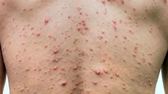 مرگ بالای 25 درصد از مبتلایان به HIV در 1400/ از کل مبتلایان سال گذشته 45 درصد بین 20 تا 35 سال بودند 