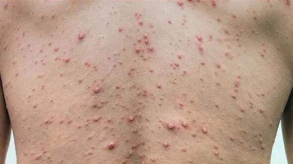 مرگ بالای 25 درصد از مبتلایان به HIV در 1400/ از کل مبتلایان سال گذشته 45 درصد بین 20 تا 35 سال بودند 