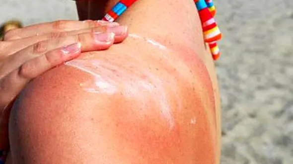  12درمان طبیعی آفتاب سوختگی پوست صورت و بد