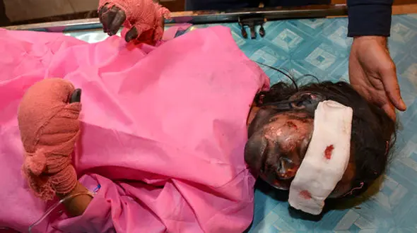 کور شدن چشمان رزیتا کوچولو بخاطر چهارشنبه سوری + عکس