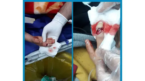 سگ وحشی کودک ایلامی را لت و پار کرد + عکس