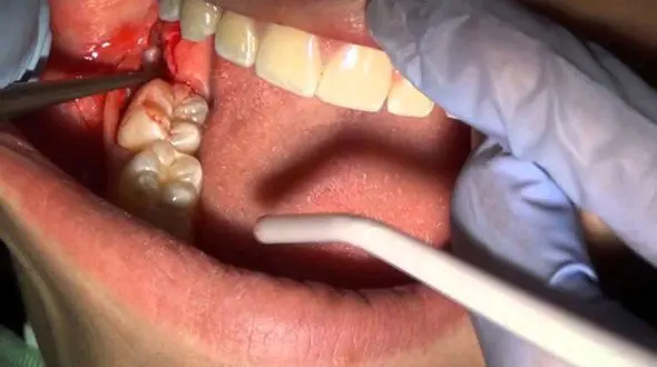 دندان عقل را نکشید چه بلایی سرتان می آید؟